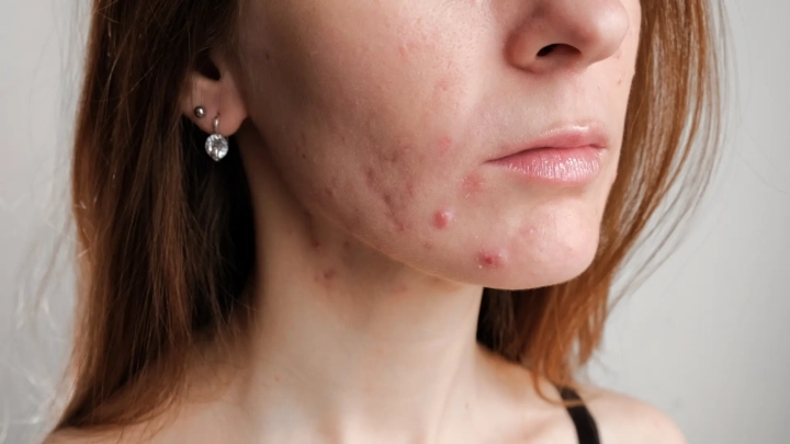 Trądzik hormonalny: dlaczego się pojawia i jak go skutecznie opanować?